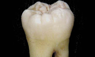 خرابی دندان,سلامت دندان