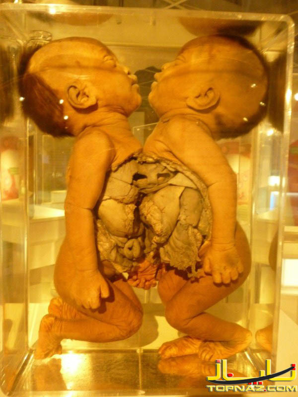 جسد جنین