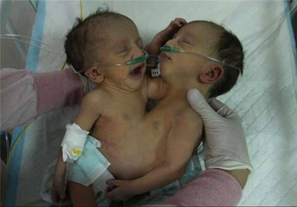 تولد دوقلوها با یک قلب مشترک! +تصاویر