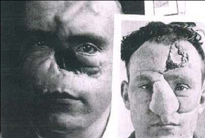 اولین عمل جراحی زیبایی بینی در دنیا
