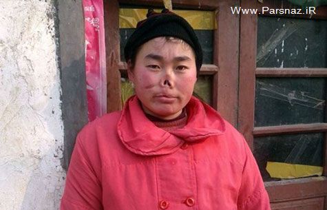 این دختر چینی لب و دماغش توسط موش خورده شد