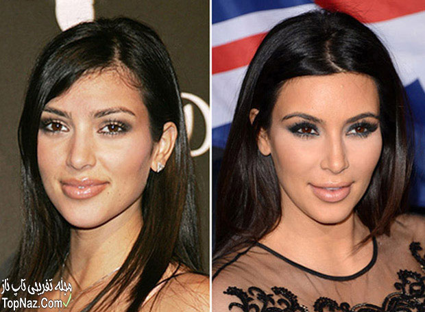 عکس کیم کارداشیان قبل و بعد از عمل زیبایی بینی
