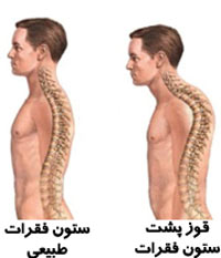 قوز کمر