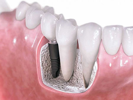 مراحل ایمپلنت دندان, ایمپلنت کامل دندان