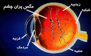 مشکل نقطه های سیاه در چشم یا مگس پران