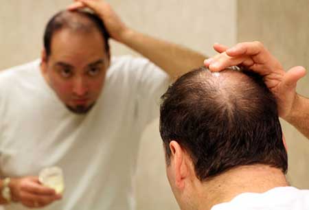 علت ریزش موی مردان