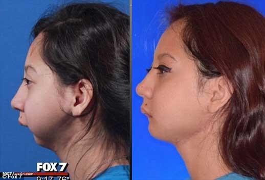عکس از تغییر چهره دختری بدون فک پس از جراحی زیبایی
