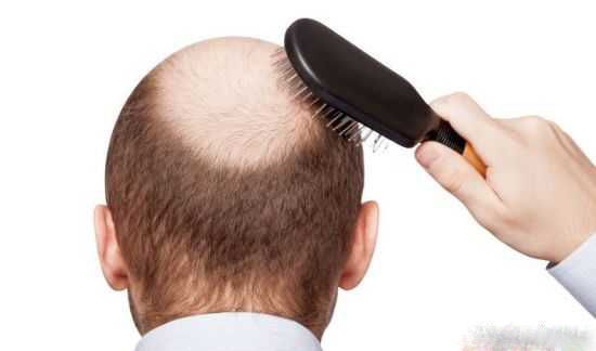 درمان آسان ریزش مو با نسخه های پیازی