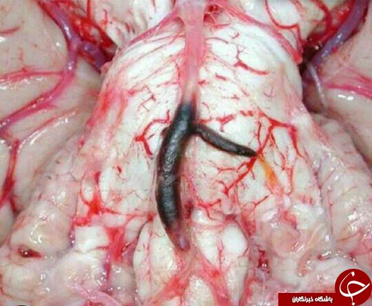 عکس از درون مغز انسان پس از سکته مغزی