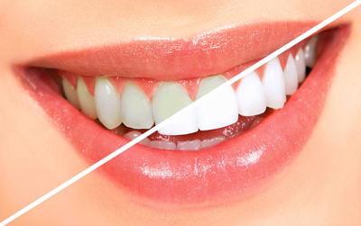 سفید کردن دندان ها برای نوروز با سفیدکننده های خانگی