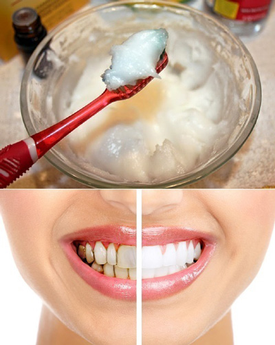 سفید کردن دندان ها برای نوروز با سفیدکننده های خانگی