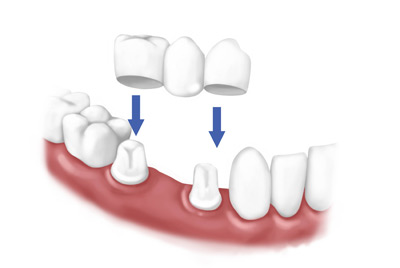 پروتز دندان ثابت,پروتز دندان,بریج دندان
