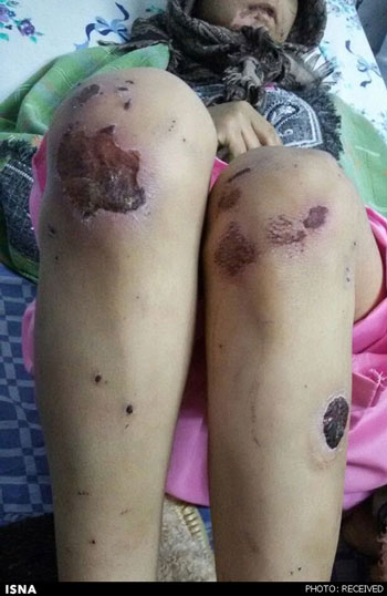 عکس های شکنجه و سوزاندن زن و دخترانش توسط شوهر معتاد! (16+)
