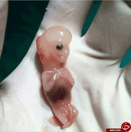 عکس غم انگیز و شوکه کننده از جنین سقط شده!