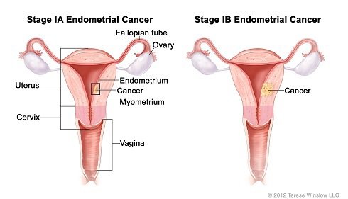 stage1-ebdometrial-cancer.jpg