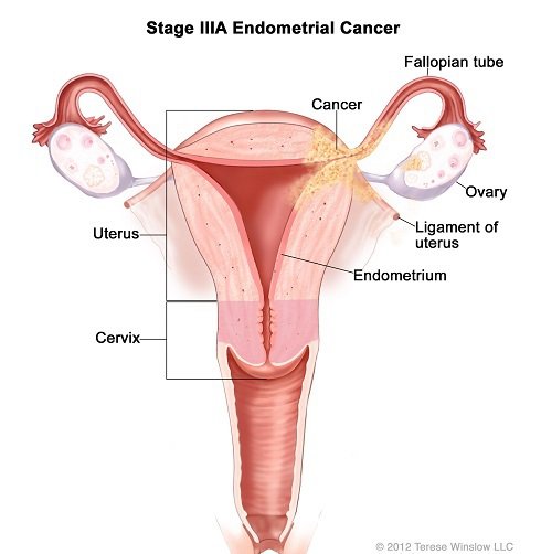 stage3a-ebdometrial-cancer.jpg