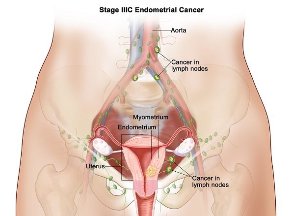 stage3c-ebdometrial-cancer.jpg