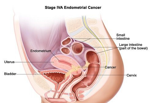 stage4a-ebdometrial-cancer.jpg