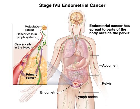 stage4b-ebdometrial-cancer.jpg
