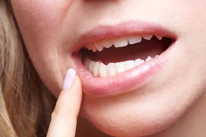 با روش خانگی آفت دهان را درمان کنید