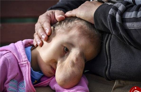 عکس های دختری که یک توده وحشتناک بزرگ روی صورتش درآمده است!