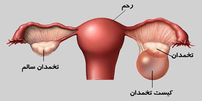 جراحی کیست تخمدان