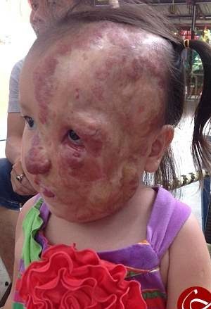 عکس دختری زیبا که تومور سرطانی نصف صورتش را خورد! + عکس