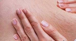 درمان ترک های پوستی و پیشگیری از ترک های پوستی