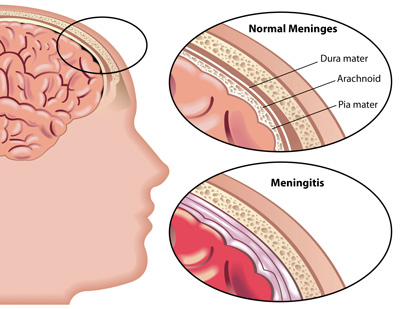 علائم و نشانه های بیماری مننژیت که باید بدانید