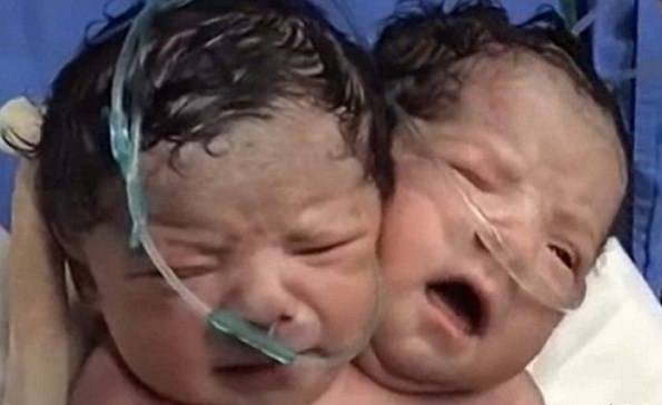 عکس نوزادی که دو سر با دو مغز روی یک بدن دارد! 