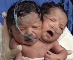 عکس نوزادی که دو سر با دو مغز روی یک بدن دارد! 
