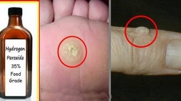 از بین بردن زگیل های روی صورت و دست پا با این روش های موثر