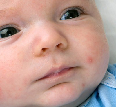 مشکل پوستی اگزما در کودکان