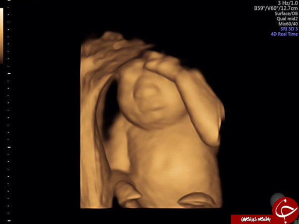 اهدای عضو جنین و نوزاد قبل از متولد شدن! 