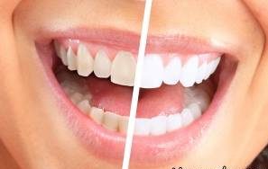 بلیچینگ دندان و انواع روش بلیچینگ دندان