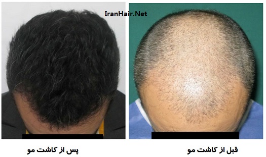 روش های کاشت مو در ایران