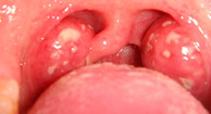 گلودرد ناشی از التهاب حاد لوزه ها یا Acute-tonsilitis