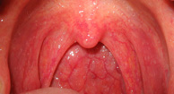 گلودرد ناشی از التهاب گلو یا Pharyngitis