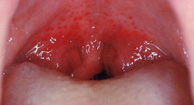 گلودرد استرپتوکوکی یا Streptococcal Pharyngitis