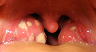 گلودرد ناشی از ورم لوزه یا Tonsillitis