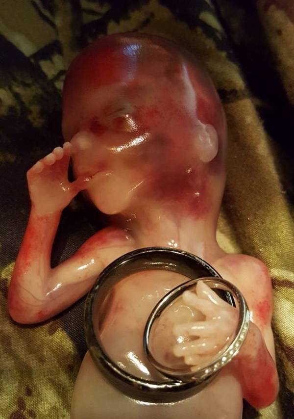 ماجرای ناراحت کننده سقط جنین 14 هفته ای (تصاویر 16+)