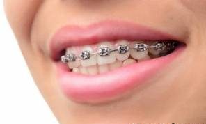انجام ارتودنسی باعث بیشتر شدن عمر دندان می شود