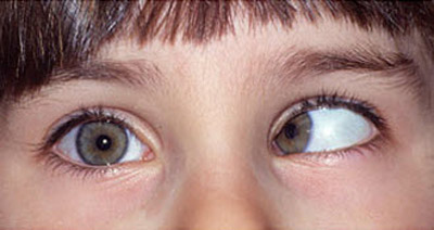 دلیل (لوچی یا استرابیسم) یا انحراف چشم ها چیست؟