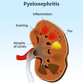 Pyelonephritis پیلونفریت بیماری عفونت کلیه