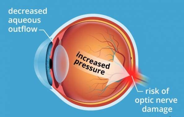 دلیل بالا رفتن فشار چشم چیست؟ درمان سریع فشار چشم