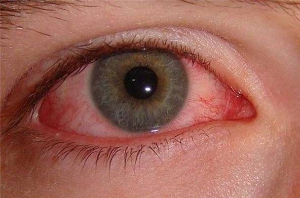 تشخیص بیماری ها از روی رنگ چشم و حالت چشم ها