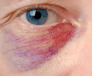 روش های درمان کبودی زیر چشم و از بین بردن کبود بر اثر ضربه