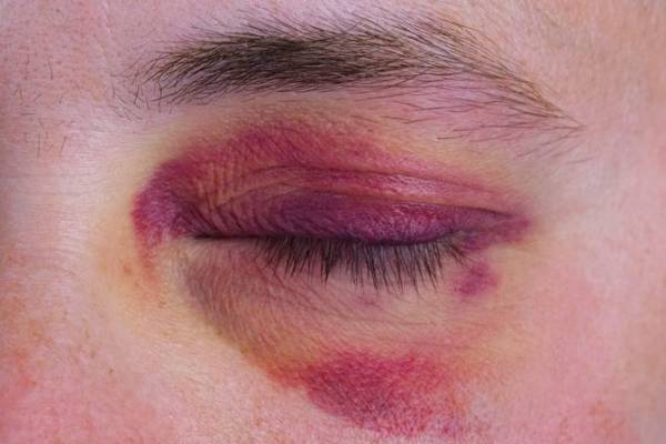 درمان کبودی زیر چشم