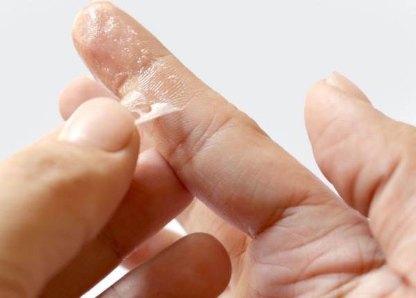نحوه پاک کردن چسب قطره ای روی پوست دست