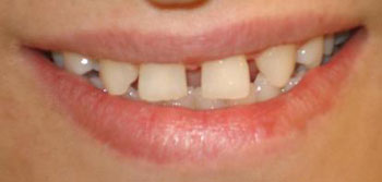 فاصله دندان